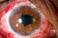Ocular trauma (after)
