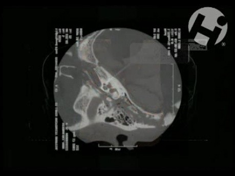 Volumated Skull and Brain