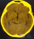 Endoscopic Third Ventriculostomy in a Benign Case of Aicardi Syndrome with Obstructive Hydrocephalus and Chiari Malformation type 1