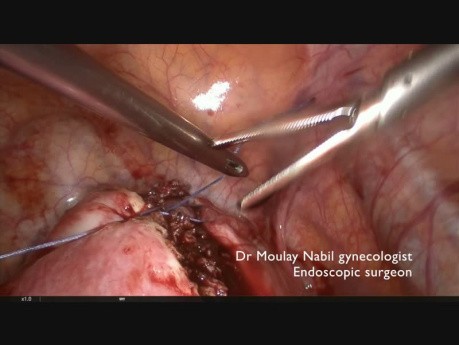 Fertility Myomectomy