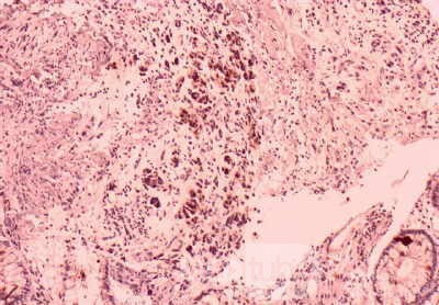 Gastrointestinal Stromal Tumour of the Rectum (4 of 5)