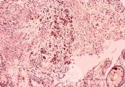 Gastrointestinal Stromal Tumour of the Rectum (4 of 5)