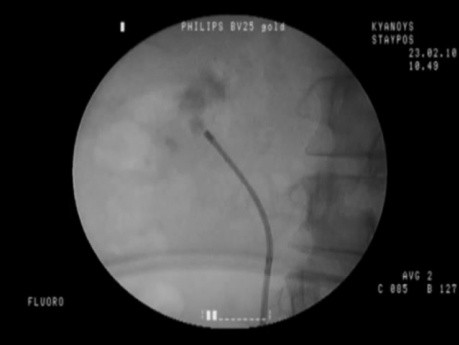 RIRS - Lower Pole Stone