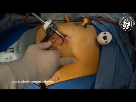 A Rare Case of Pigment Gallstones and a Concomitant Gastric GIST