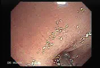 Polyp Inside Of A Diverticulum (3 of 12)