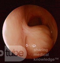 Choanal Polyp Arising From the Left Posterior Nasal Septum