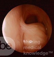 Choanal Polyp Arising From the Left Posterior Nasal Septum