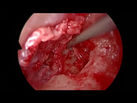 Chronic Otitis Media Endoscopic Tympanoplasty
