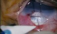 Trabeculectomy For Congenital Glaucoma