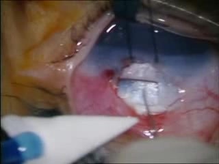 Trabeculectomy For Congenital Glaucoma