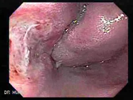 Long Standing Alcohol Abuse - Endoscopy One Week After Ligation