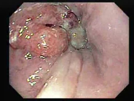 Adenocarcinoma of the Esophagus and Gastric Fundus (1 of 3)