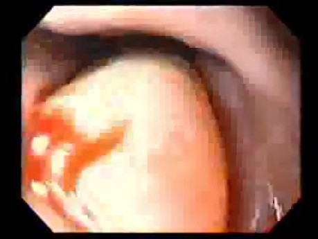 Severe Epistaxis - Case Study  (5 of 8)