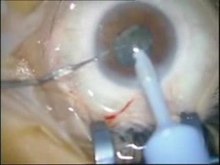 Cataract Surgery - Phacoemulsification