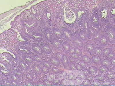 Case on Multiple Adenomas (large polyps) of the Rectum (32 of 37)