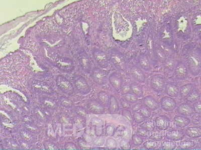 Case on Multiple Adenomas (large polyps) of the Rectum (32 of 37)