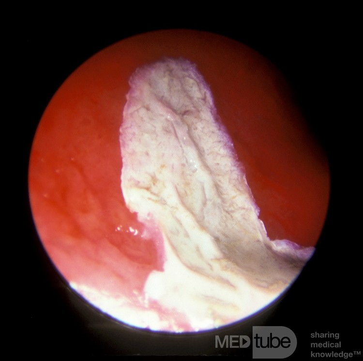 Nasal Septum Post Cauterization with Silver Nitrate