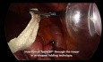 Surgical Technique for TachoSil® Use in Bariatric Surgery for Sufficient Hemostasis and Sealing in MIS Roux-en Y Gastric Bypass Procedure