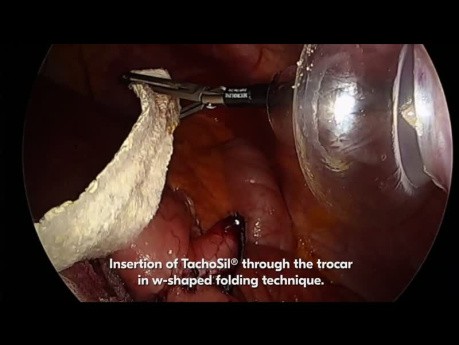 Surgical Technique for TachoSil® Use in Bariatric Surgery for Sufficient Hemostasis and Sealing in MIS Roux-en Y Gastric Bypass Procedure