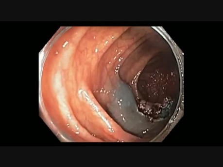 Endoscopic Mucosal Resection of A Large Transverse Colon Polyp In A Patient With MYH-Associated Polyposis