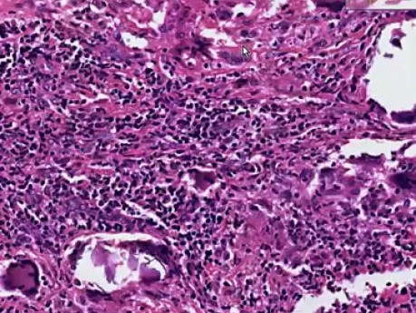 Temporal arteritis - Histopathology  - Temporal artery
