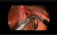 Laparoscopic Heller's Cardiomyotomy Complicated by Perforation of the Esophageal Mucosa