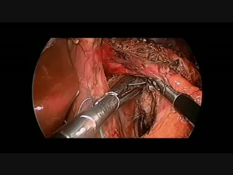 Laparoscopic Heller's Cardiomyotomy Complicated by Perforation of the Esophageal Mucosa