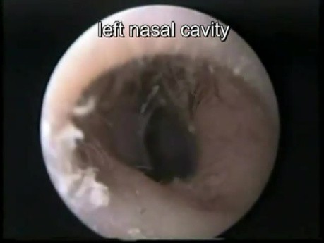 Nose: Foreign Body 