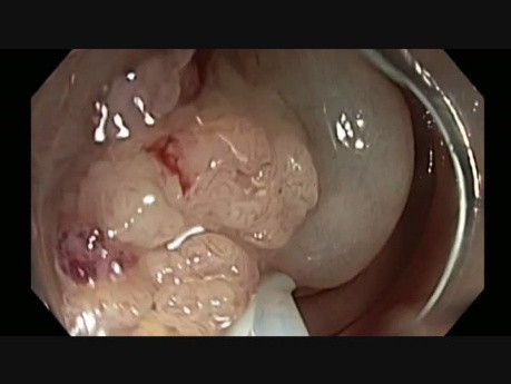 Colonoscopy - Ascending Colon Giant Polyp Resection - step 1 injection