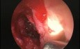 Anterior Wall Sphenoid Sinusotomy - Endoscopy