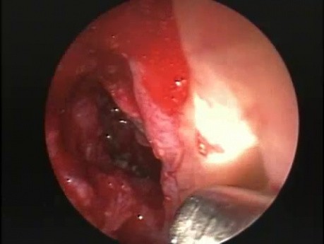 Anterior Wall Sphenoid Sinusotomy - Endoscopy