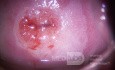 Colposcopy - CIN1