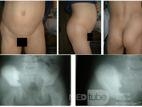 Ewings Sarcoma of iliac bone