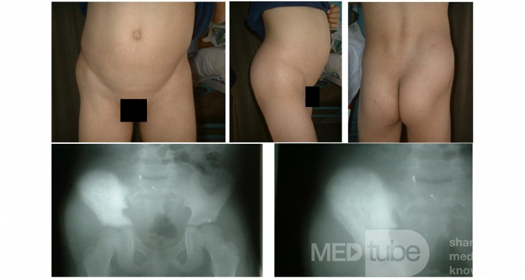 Ewings Sarcoma of iliac bone