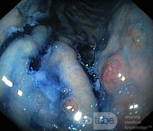 Unusual Appearance of Fundic Polyps. Chromoendoscopy. NET (6/6)
