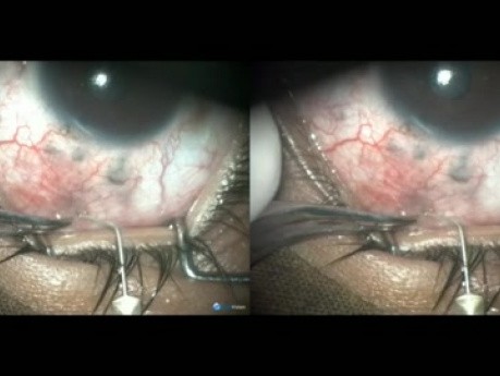 Buphthalmos, Failed Surgery, 4th Operation