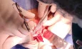 Achalasia in Pediatric, Operated with Heller's Cardiomyotomy