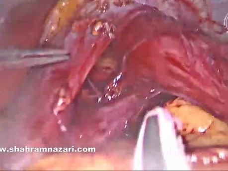 Laparoscopic Heller Myotomy and Dor Fundoplication for Treatment of Achalasia