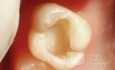Aesthetic and Functional Composite Restoration
