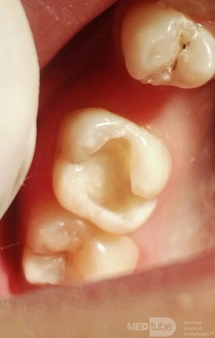 Aesthetic and Functional Composite Restoration