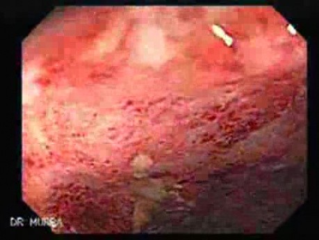 Colitis Ulcerosa - Pancolitis (2 of 7)
