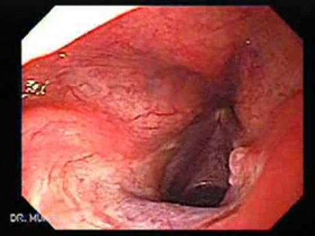 Laryngopharyngeal reflux (LPR) (1 of 2) State after PPI Therapy