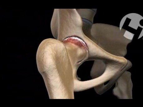 Future Hip Replacement