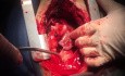 How Simply Manage RA and RV Perforations During Internal Pace Insertion 