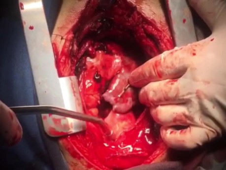 How Simply Manage RA and RV Perforations During Internal Pace Insertion 