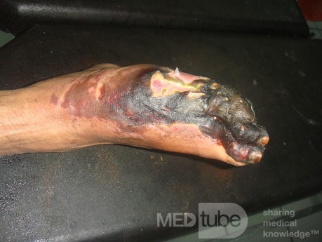 Neglected ischemic diabetic foot