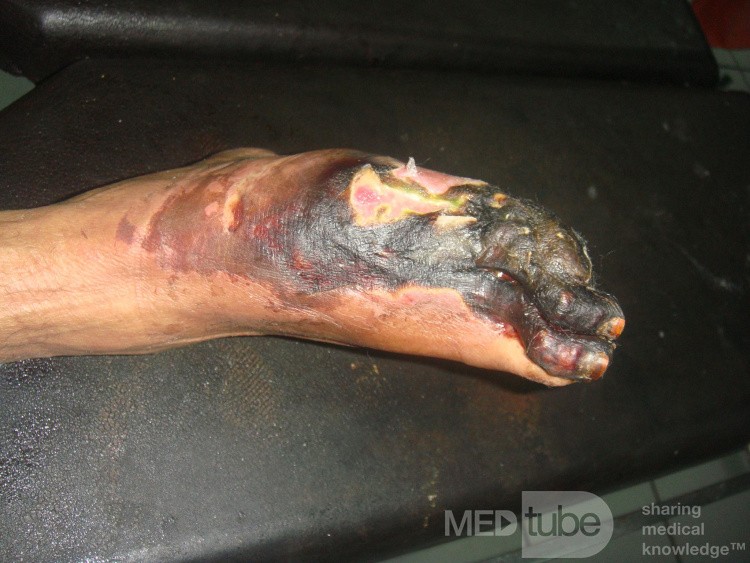 Neglected ischemic diabetic foot