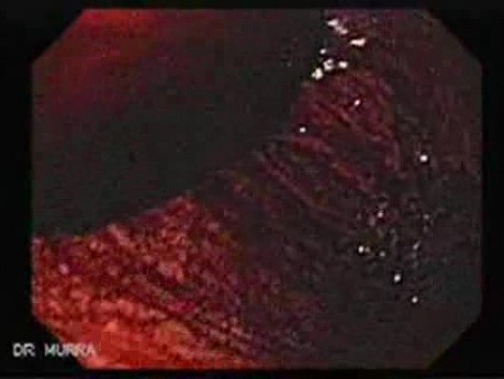 Endoscopy of Mallory Weiss Tear - 38 Years-Old Male
