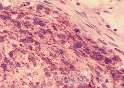 Gastrointestinal Stromal tumor (GIST) (65 of 65)