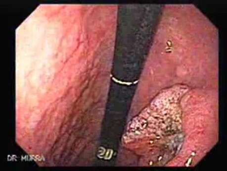 Adenocarcinoma of the Corpus (2 of 6)